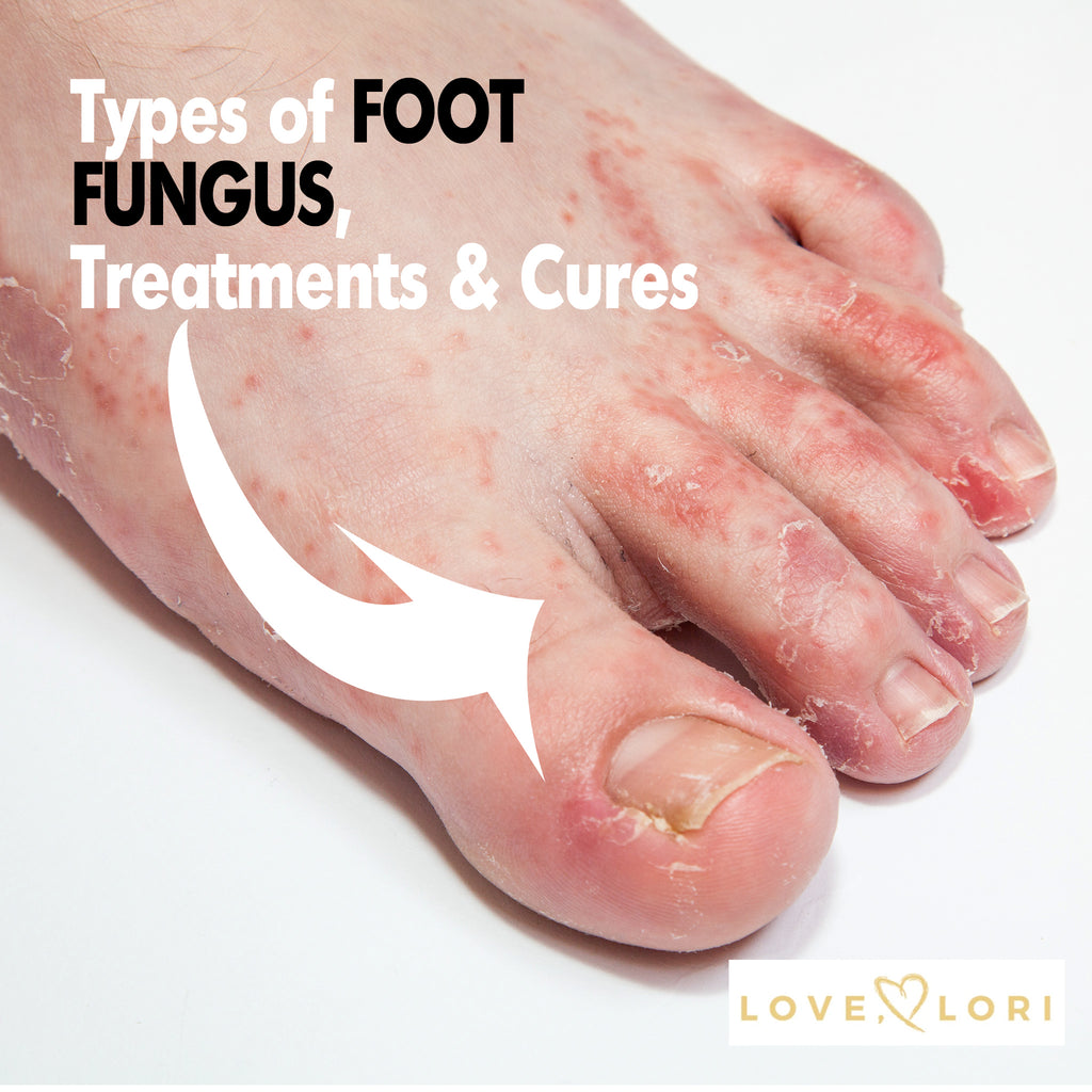 Fungal Acne Forehead
