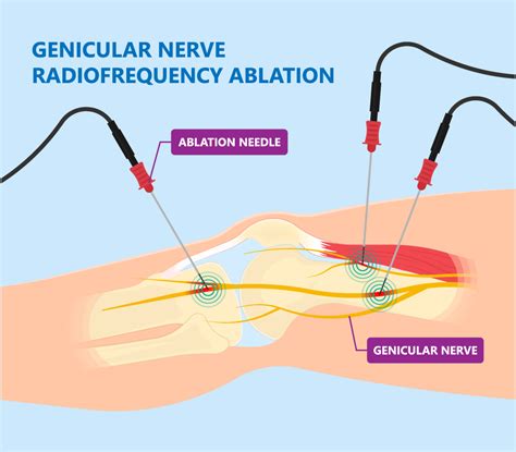 Genicular Nerve Block