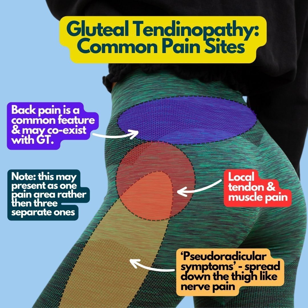 Gluteal Superior Nerve