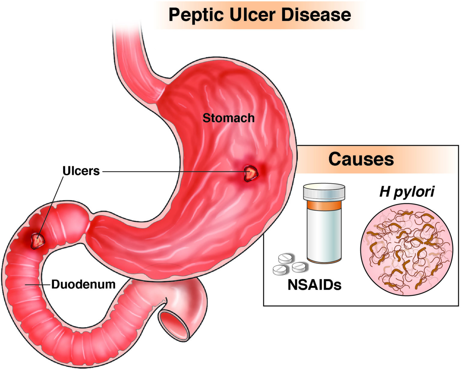 Helicobacter Pylori Bacteria