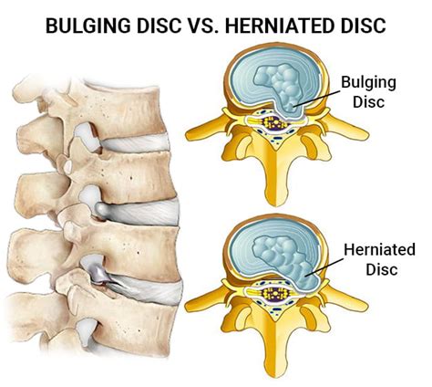 Herniated Vs Bulging Disc
