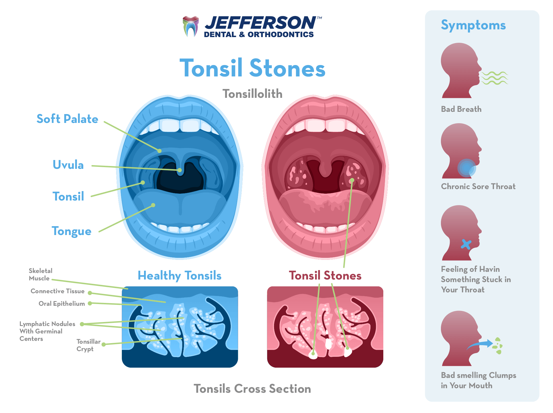 How Big Can Tonsil Stones Get The Shocking Truth About Size