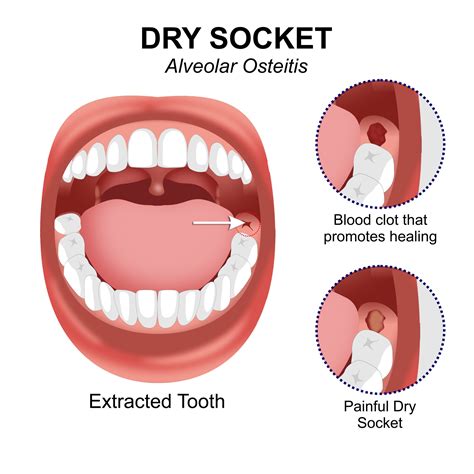How Common Is Dry Socket Wisdom Teeth