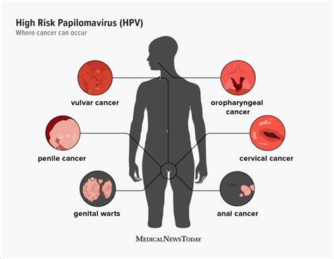How Common Is Hpv