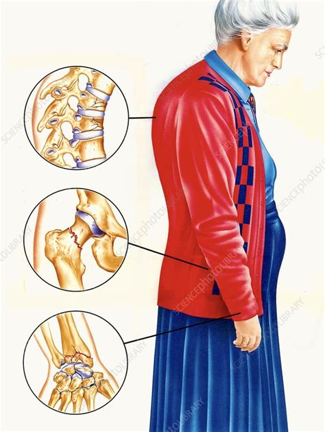 How Common Is Osteoporosis