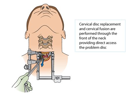 How Dangerous Is Neck Disc Surgery