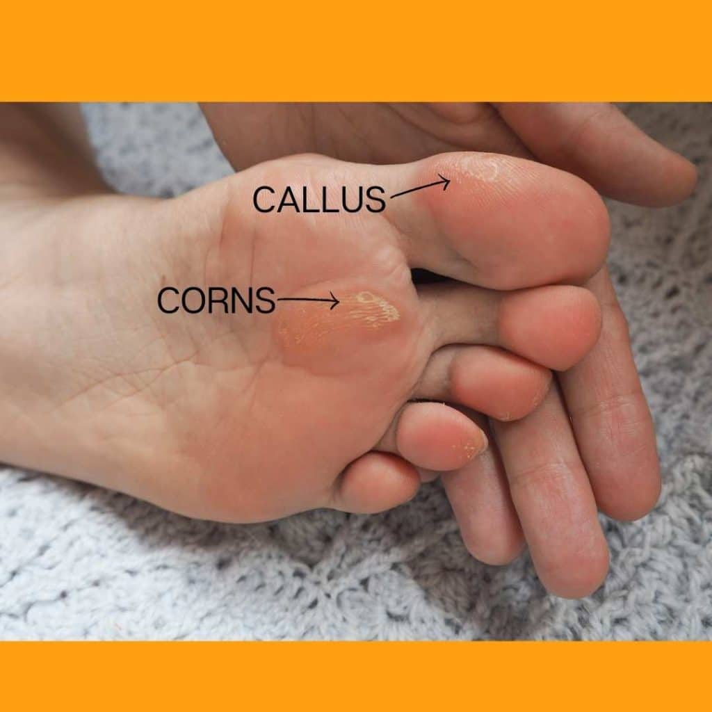 How Deep Do Foot Corns Actually Go Before They Become Dangerous