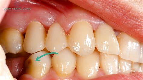 How Do Cavities Look Like