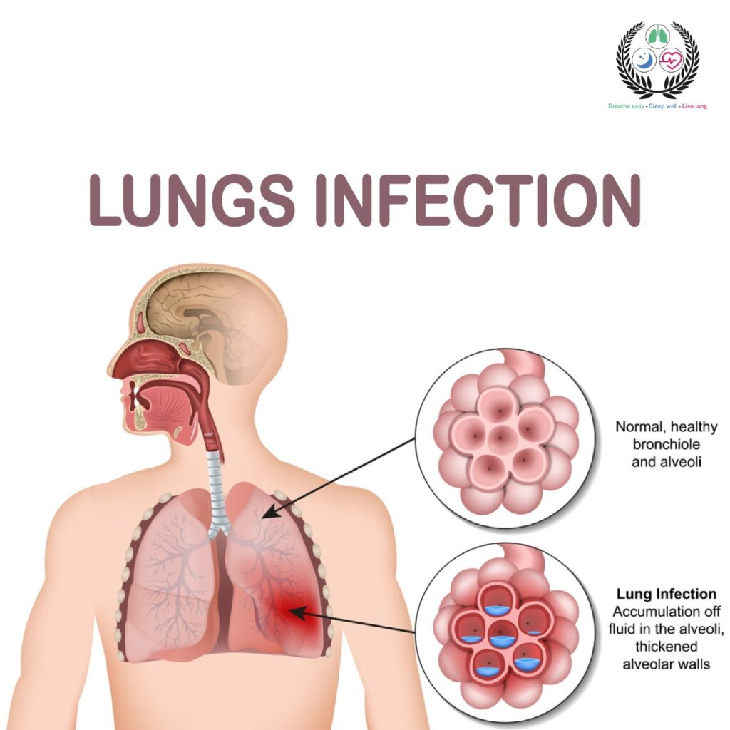 Detect When Your Lungs Get Inflamed: Early Signs To Watch For
