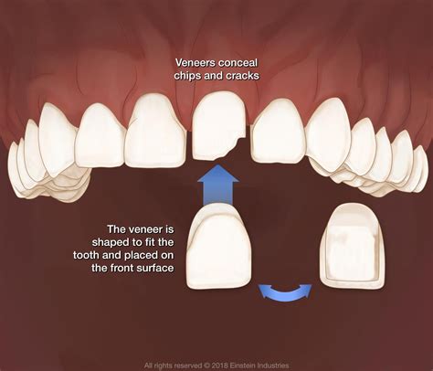 How Do Veneers Work