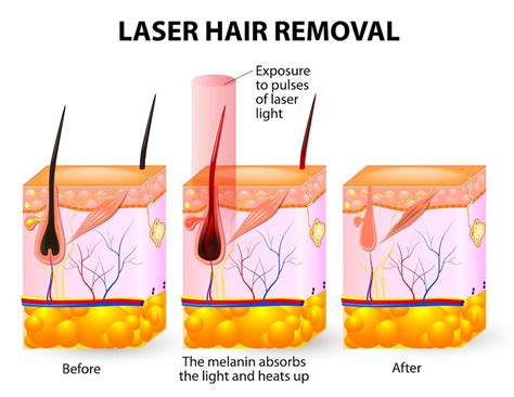 How Does It Work Laser Hair Removal