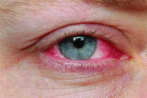 How Does One Get Pink Eye