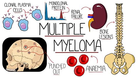 How Fast Can Multiple Myeloma Kill You