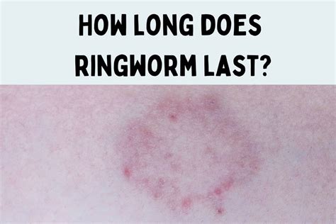 How Long Does Ringworm Last