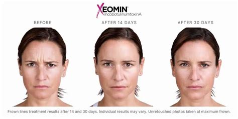 How Long Does Xeomin Last