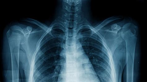 How Long Have Xrays Been Around