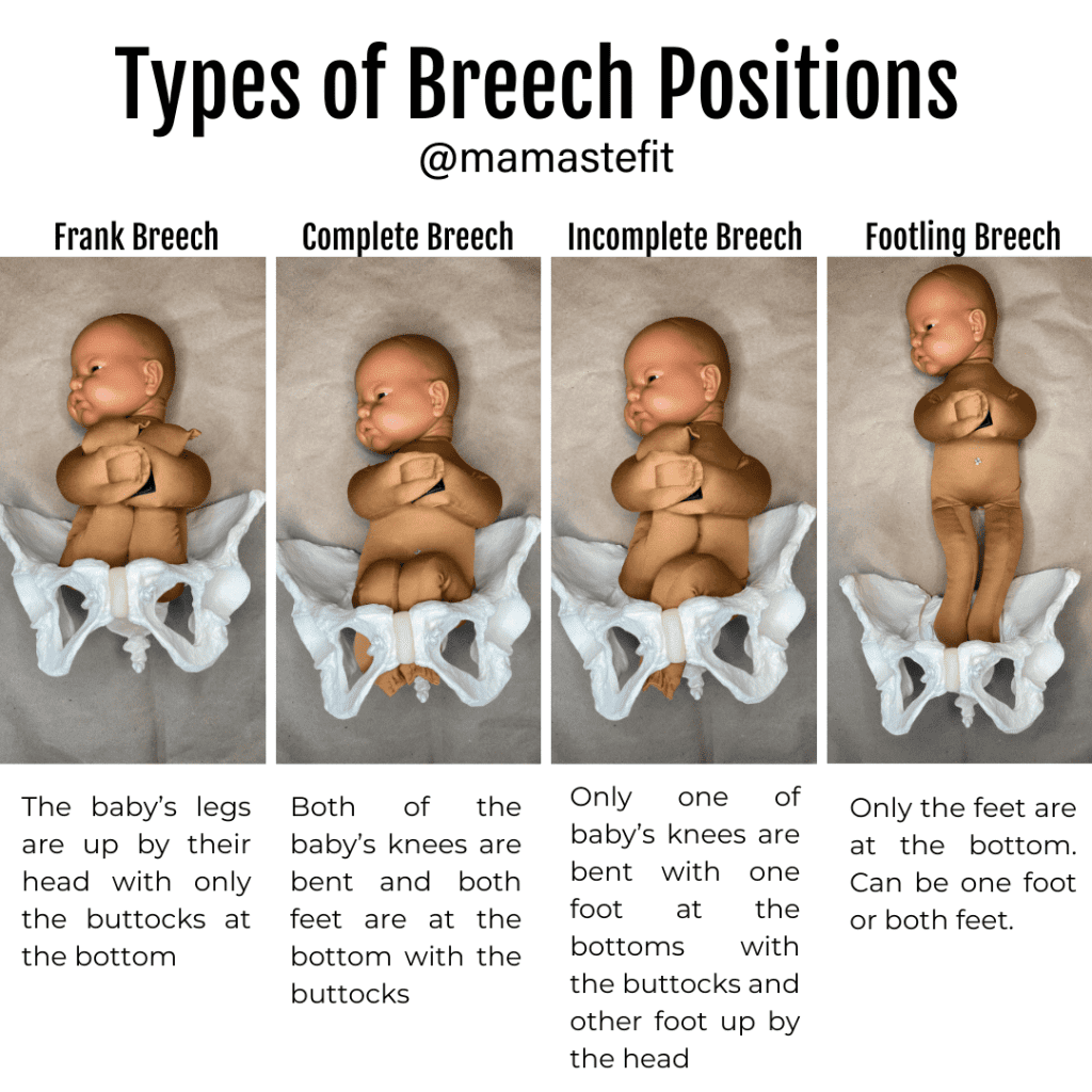 Straightforward Ways To Avoid Breech Position During Pregnancy