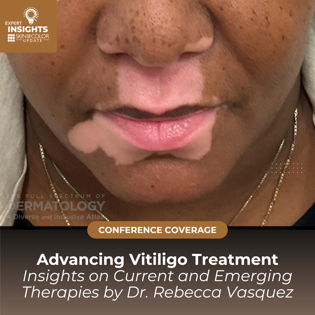 Proven Steps On How To Avoid Vitiligo Before It Starts