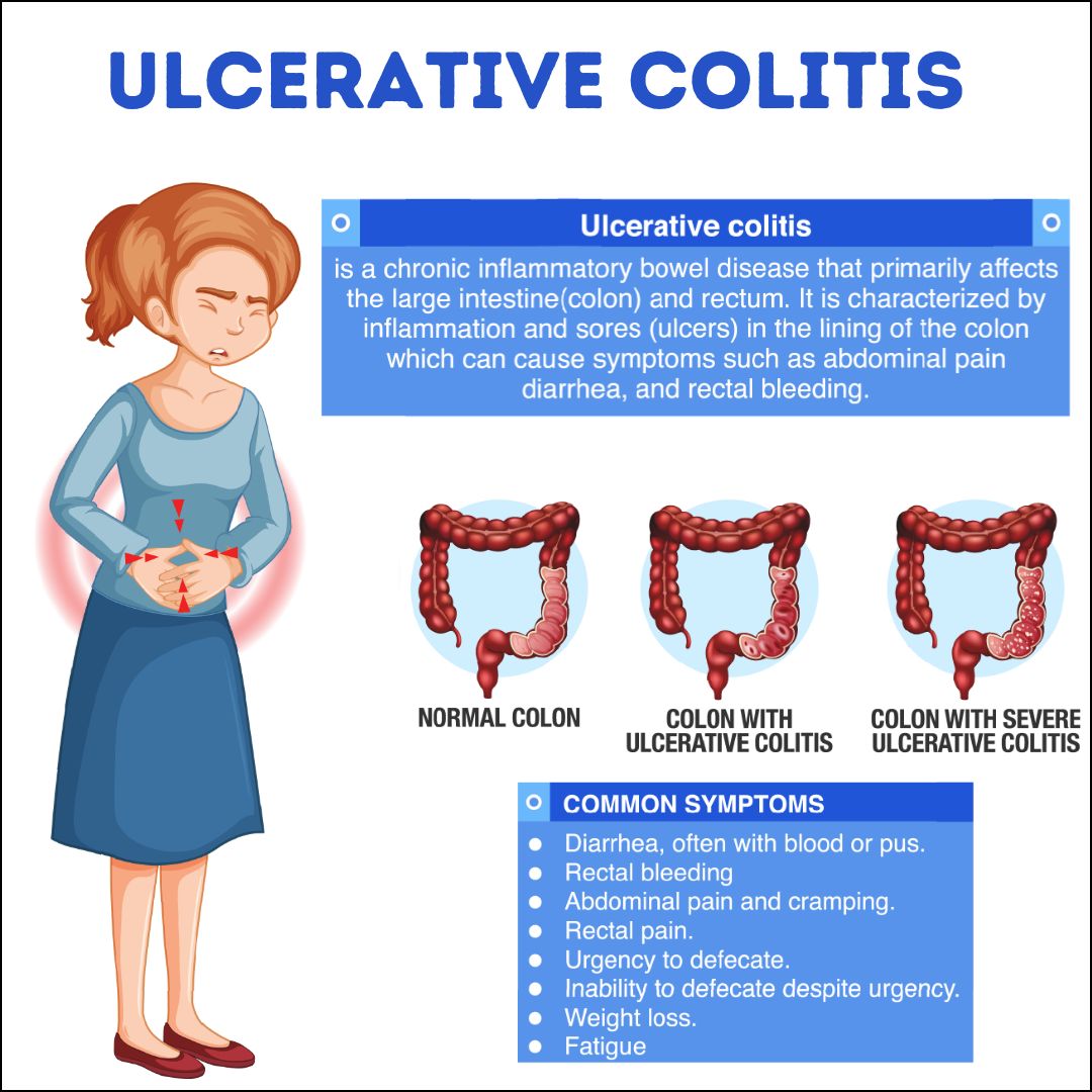 How To Help Someone With Ulcerative Colitis So They Don't Feel Alone