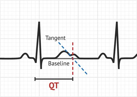 How To Measure Qt Interval