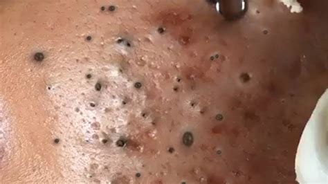 How To Remove Deep Blackheads
