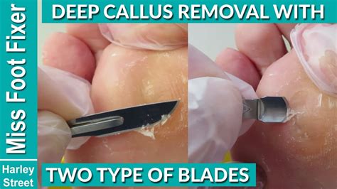 How To Remove Foot Callus