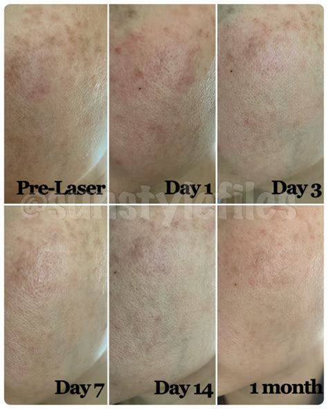 How To Remove Sun Spots