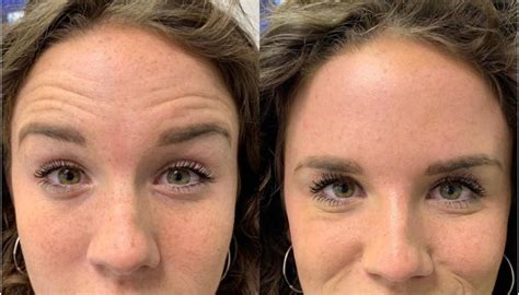 How To Rid Forehead Lines