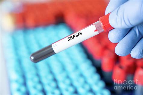 How To Test For Sepsis