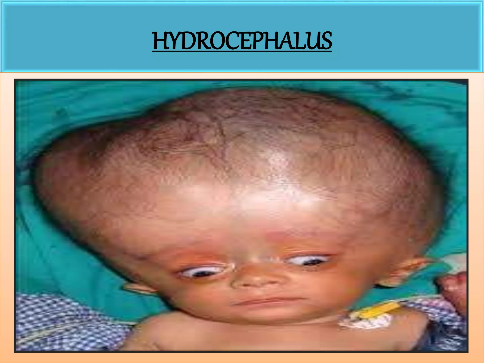 Hydrocephalus Ex Vacuo