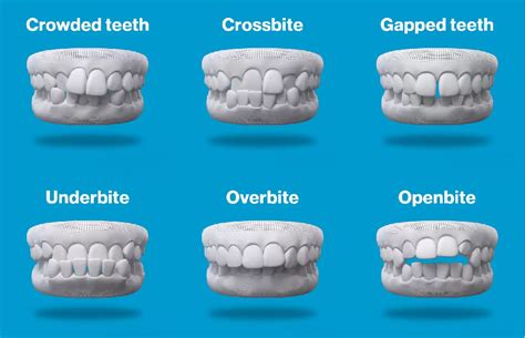 Unlock Your Best Smile with Affordable Invisalign Treatment Canada
