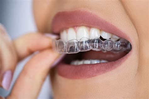 Discover the Best Invisalign Treatment Specialist Near You Today