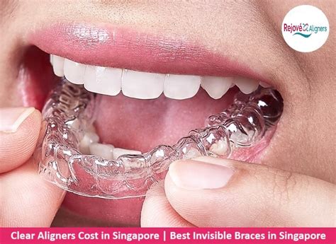 Invisible Braces Cost in Singapore: Surprising Facts!
