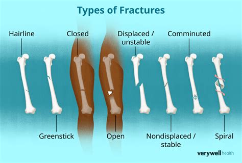 Is A Fracture A Break