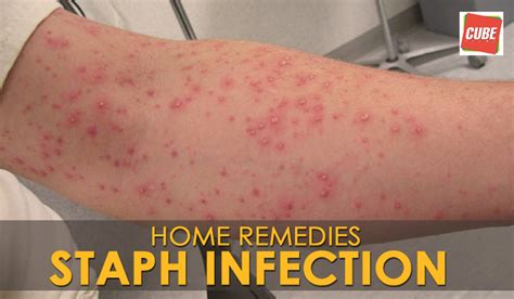 Is All Staph Infection Contagious