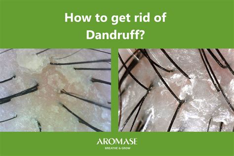 Is Dandruff Spreadable