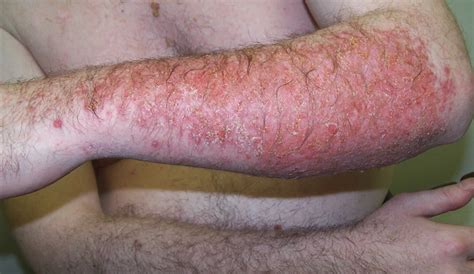 Is Dermatitis Spreadable