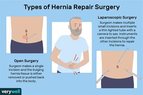 Is Hernia Surgery Dangerous