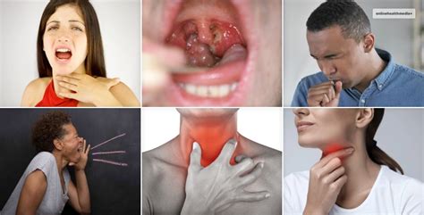 Is Laryngitis Contagious