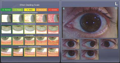 J And J Eye Scale