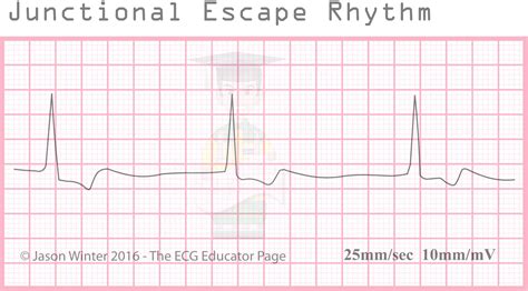 Junctional Escape Rhythm