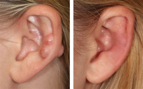 Keloid Scar Piercing