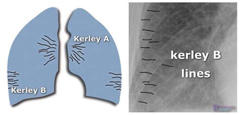 Kerley B Lines