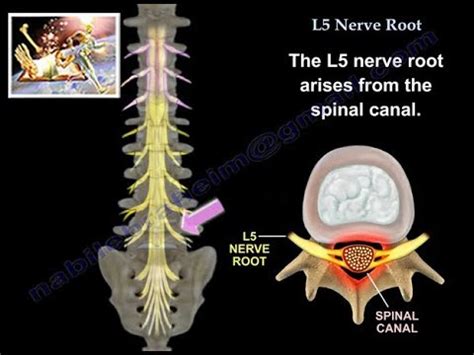 L5 Nerve Root