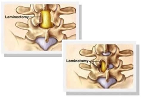 Laminectomy Vs Laminotomy