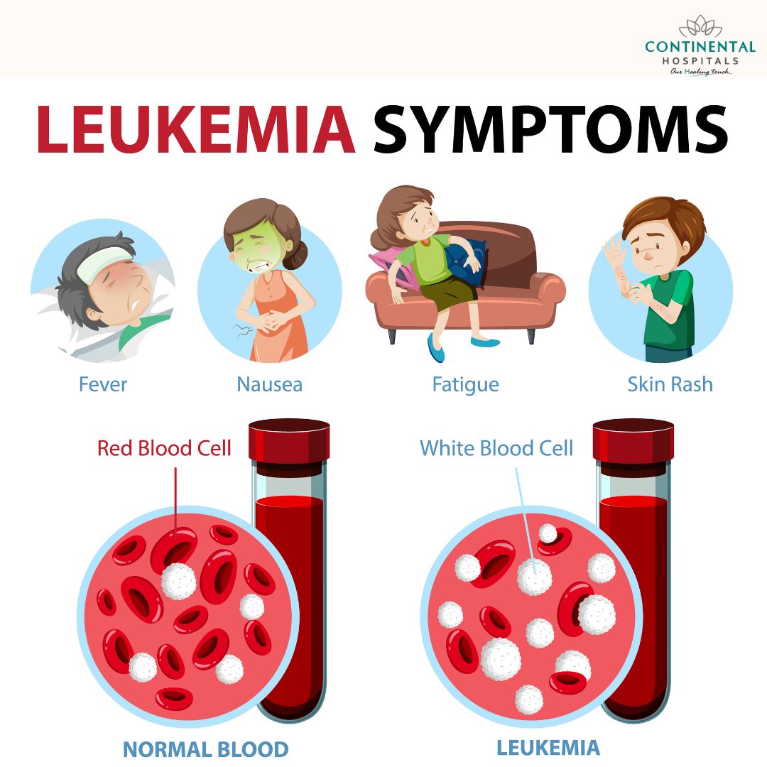 Leucemia Linfoblastica Aguda