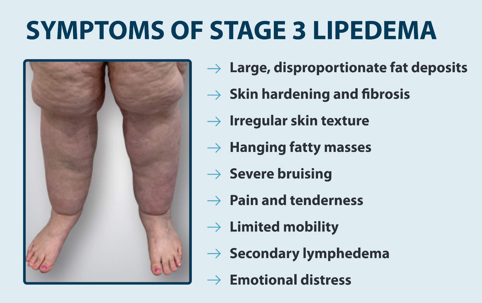 Lipedema In Arms