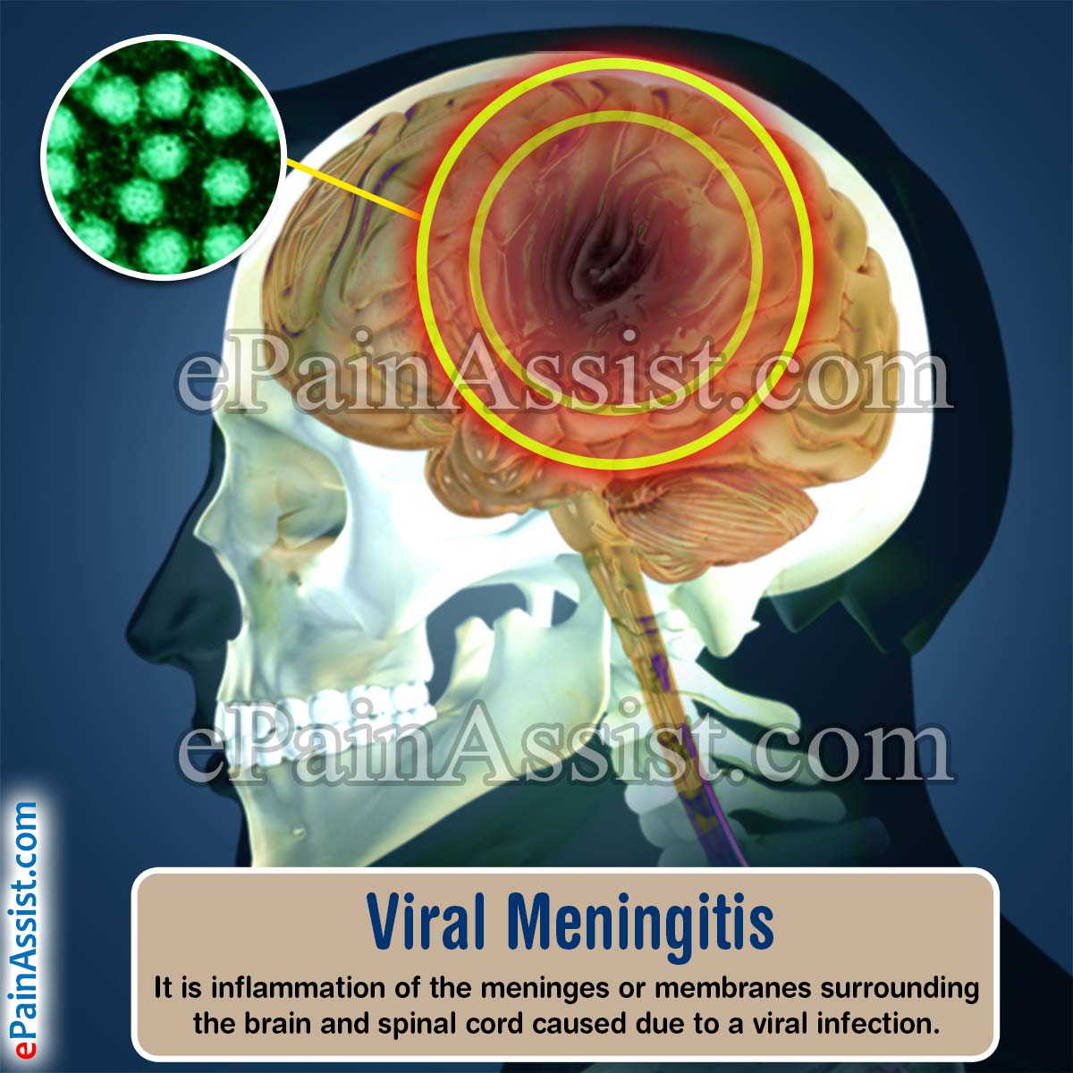 Meningitis Does It Affect Older People