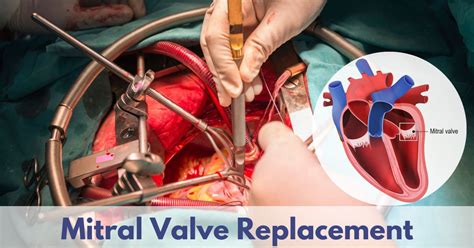 Mitral Replacement Valve