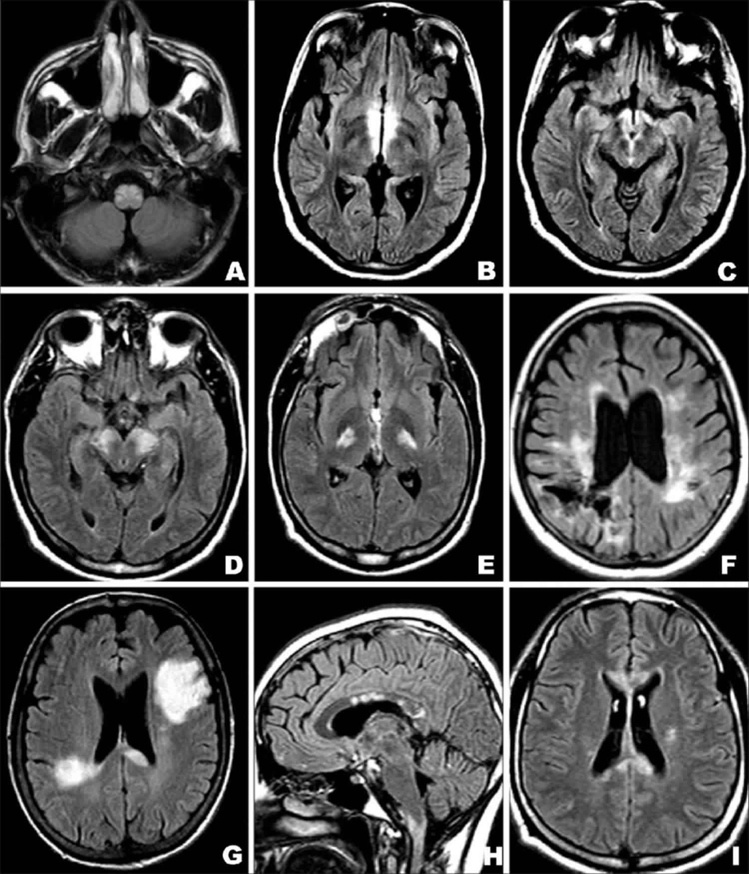 Mri With Contrast